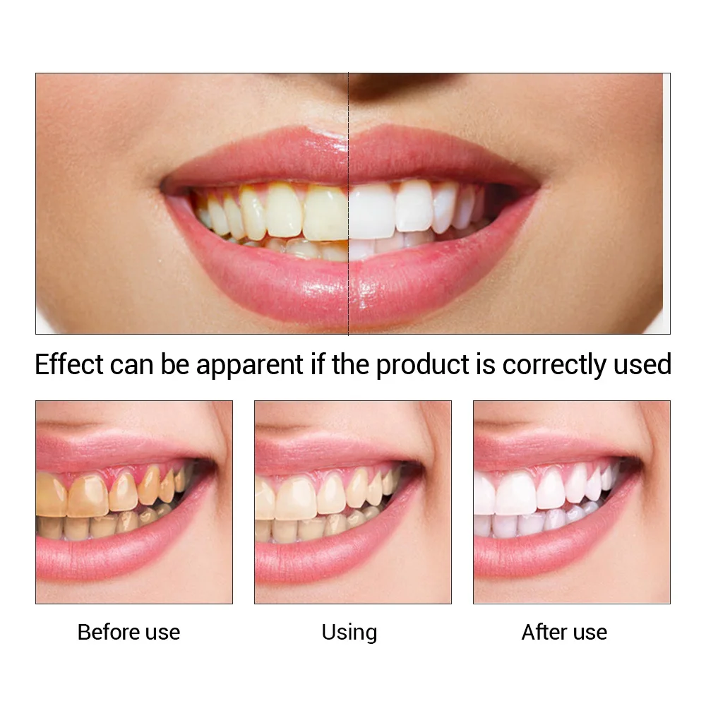 Fteenply Tanden Whitening Esse - Teeth Whitening Results recensie en prijs