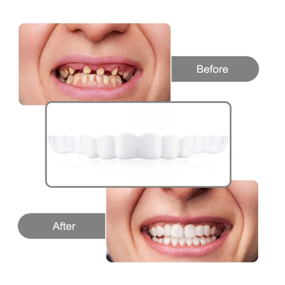 4-6 paar boven- en onderkaak k - Teeth Whitening Moulds recensie en prijs