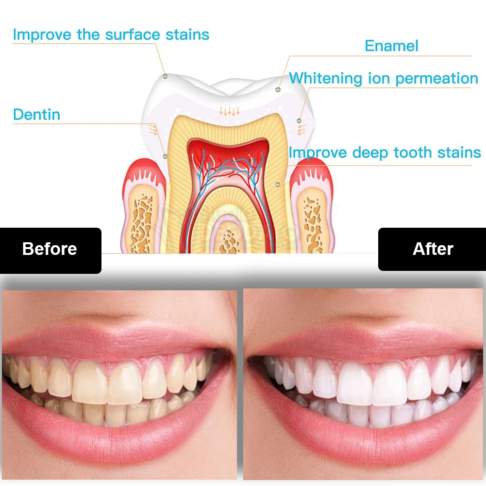 Tandheelkundige Tanden Whiteni - Teeth Whitening Results recensie en prijs