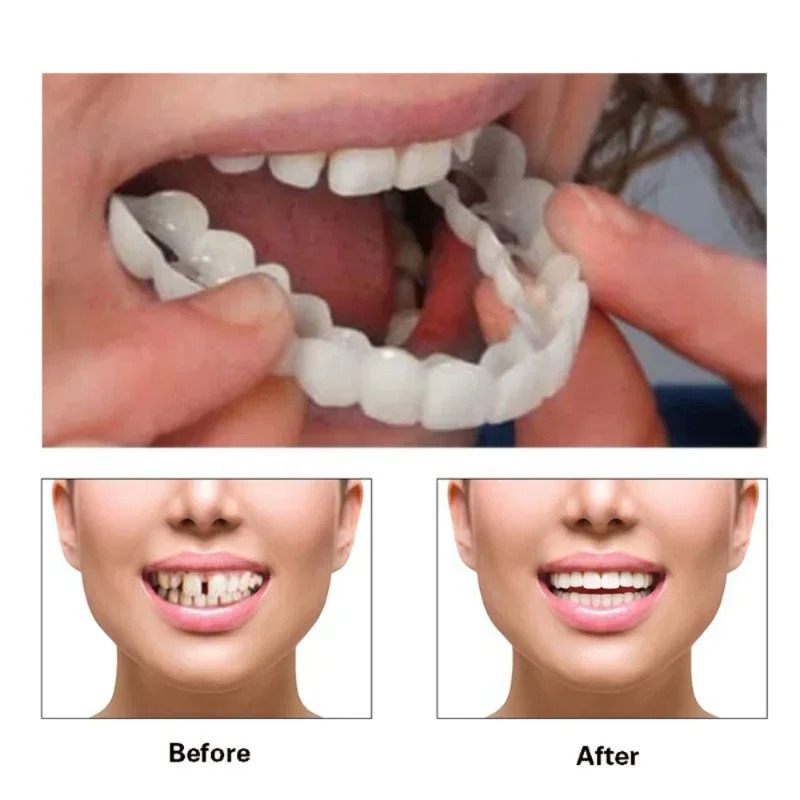 Perfect Fit Tanden Whitening V - Teeth Whitening Moulds recensie en prijs