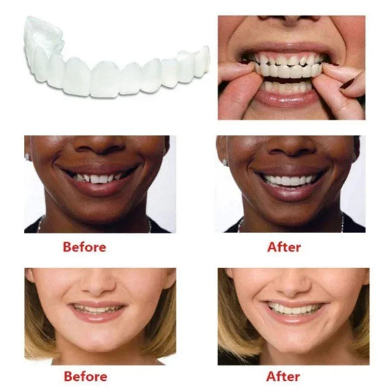 Perfect Fit Tanden Whitening V - Teeth Whitening Moulds recensie en prijs