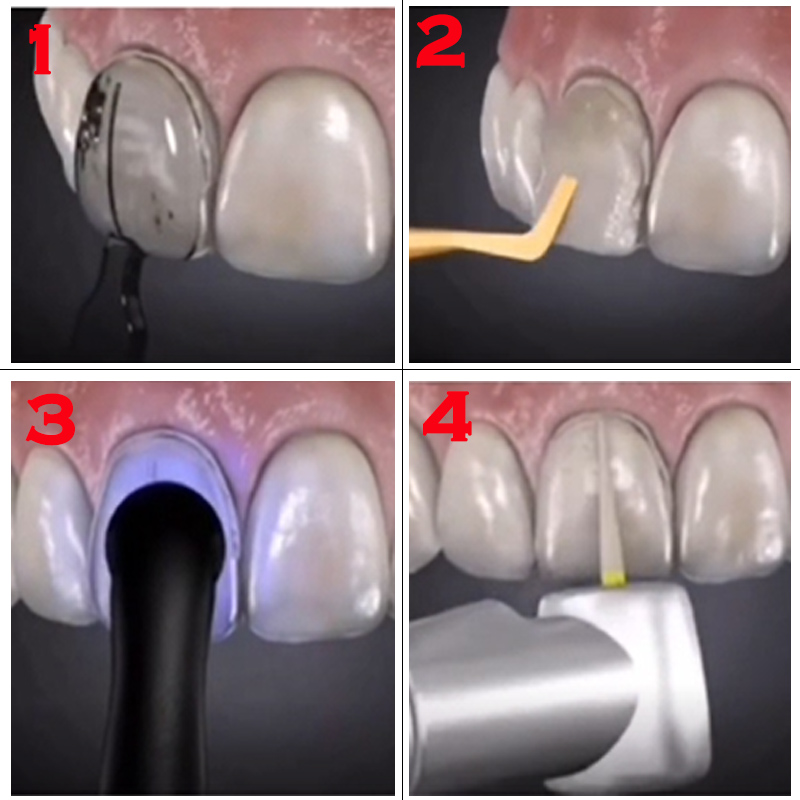 Autoclaveerbare tandvleugelmal - Teeth Whitening Moulds recensie en prijs