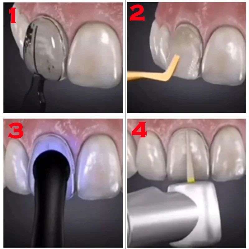Tandheelkundige mal voor compo - Teeth Whitening Moulds recensie en prijs