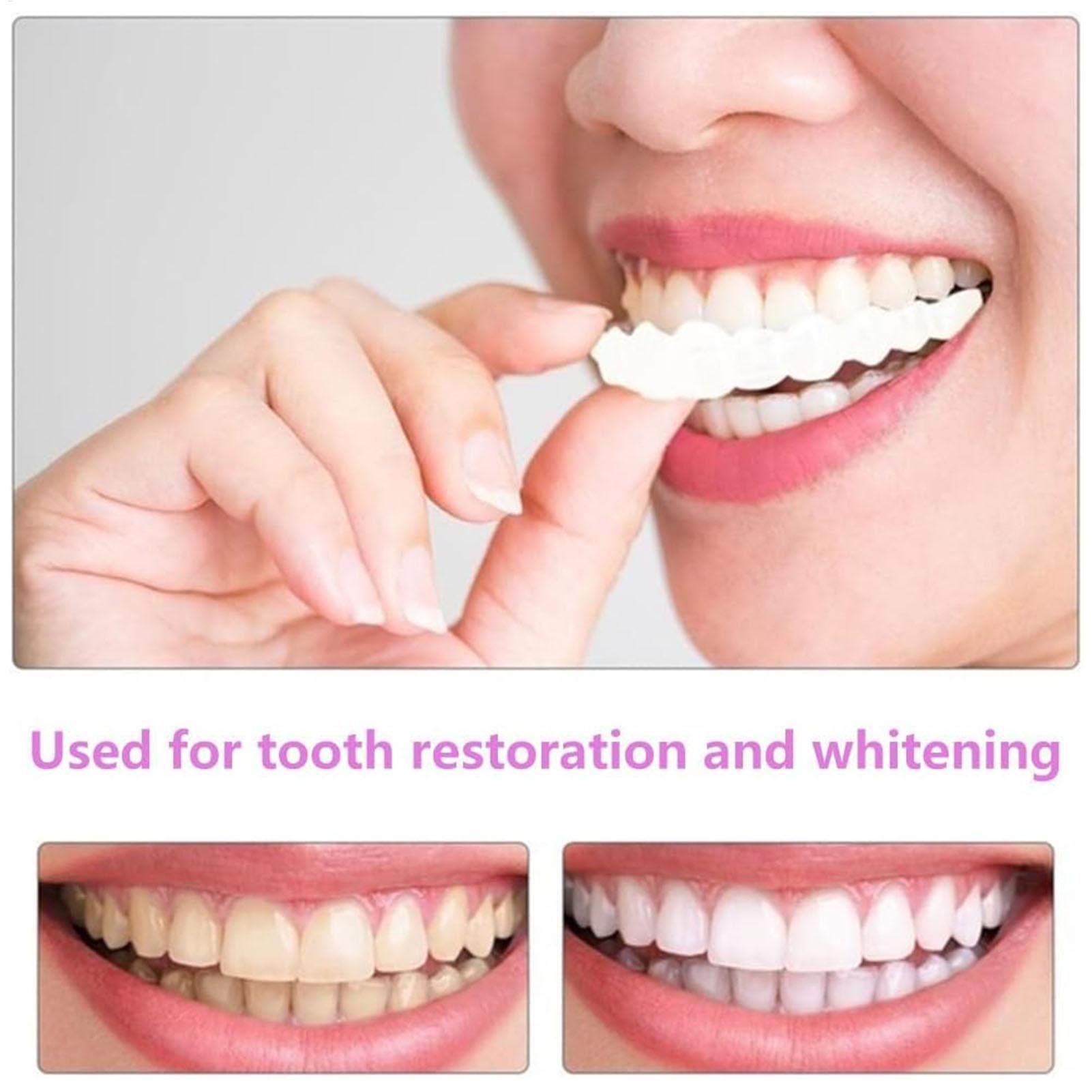 2 Stuks Mannen Vrouwen Tijdeli - Teeth Whitening Moulds recensie en prijs
